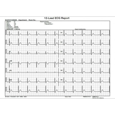 PAD ECG met interpretatie